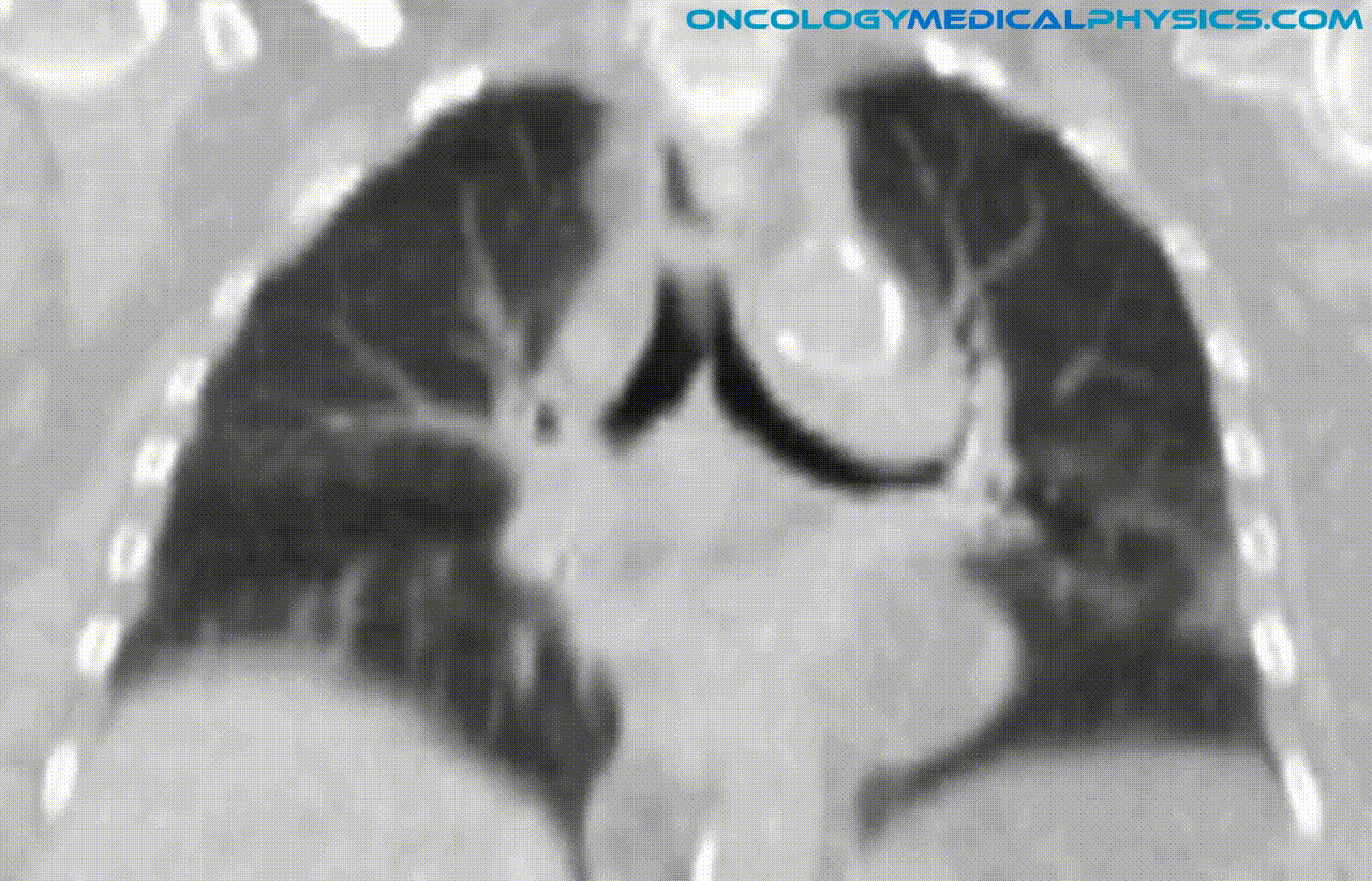lung motion